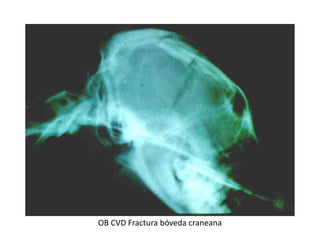 OB CVD Fractura bóveda craneana
 