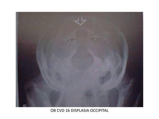 OB CVD 16 DISPLASIA OCCIPITAL
 