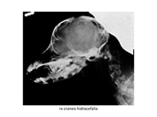 rx craneo hidrocefalia
 