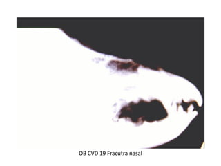 OB CVD 19 Fracutra nasal
 