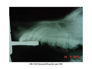 OB CVD Descalcificación por IRC
 