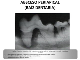 ABSCESO PERIAPICAL
                              (RAÍZ DENTARIA)




              Radiografía primer plano lateral de un absceso periapical de la raíz rostral del primer molar mandibular.
                                                             Muestra:
•   Halo radiolúcido que rodea la raíz dentaria afectada, con destrucción del hueso alveolar.
•   Ensanchamiento de l espacio periodontal que rodea al ápice.
•   Lisis ósea o esclerosis de la raíz dentaria.
 
