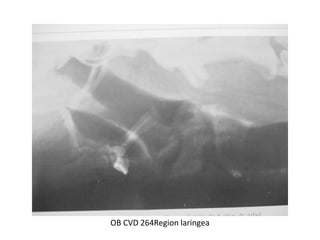 OB CVD 264Region laringea
 