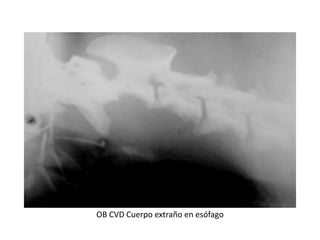 OB CVD Cuerpo extraño en esófago
 