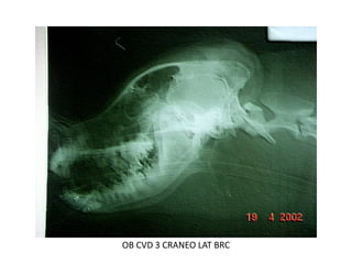 OB CVD 3 CRANEO LAT BRC
 