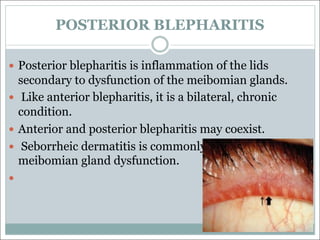 POSTERIOR BLEPHARITIS
— Posterior blepharitis is inflammation of the lids
secondary to dysfunction of the meibomian glands.
— Like anterior blepharitis, it is a bilateral, chronic
condition.
— Anterior and posterior blepharitis may coexist.
— Seborrheic dermatitis is commonly associated with
meibomian gland dysfunction.
—
 
