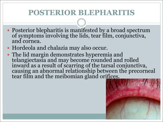 POSTERIOR BLEPHARITIS
— Posterior blepharitis is manifested by a broad spectrum
of symptoms involving the lids, tear film, conjunctiva,
and cornea.
— Hordeola and chalazia may also occur.
— The lid margin demonstrates hyperemia and
telangiectasia and may become rounded and rolled
inward as a result of scarring of the tarsal conjunctiva,
causing an abnormal relationship between the precorneal
tear film and the meibomian gland orifices.
 