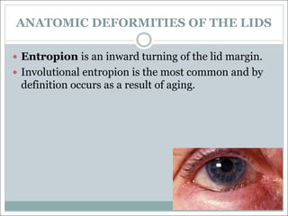 ANATOMIC DEFORMITIES OF THE LIDS
— Entropion is an inward turning of the lid margin.
— Involutional entropion is the most common and by
definition occurs as a result of aging.
 