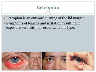 Ectropion
— Ectropion is an outward turning of the lid margin.
— Symptoms of tearing and irritation resulting in
exposure keratitis may occur with any type.
 
