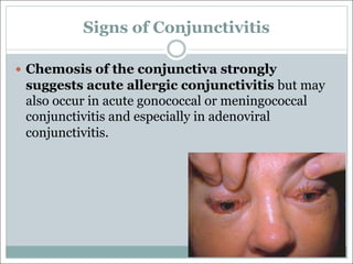 Signs of Conjunctivitis
— Chemosis of the conjunctiva strongly
suggests acute allergic conjunctivitis but may
also occur in acute gonococcal or meningococcal
conjunctivitis and especially in adenoviral
conjunctivitis.
 
