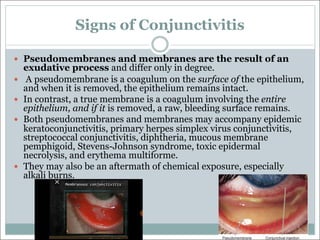 Signs of Conjunctivitis
— Pseudomembranes and membranes are the result of an
exudative process and differ only in degree.
— A pseudomembrane is a coagulum on the surface of the epithelium,
and when it is removed, the epithelium remains intact.
— In contrast, a true membrane is a coagulum involving the entire
epithelium, and if it is removed, a raw, bleeding surface remains.
— Both pseudomembranes and membranes may accompany epidemic
keratoconjunctivitis, primary herpes simplex virus conjunctivitis,
streptococcal conjunctivitis, diphtheria, mucous membrane
pemphigoid, Stevens-Johnson syndrome, toxic epidermal
necrolysis, and erythema multiforme.
— They may also be an aftermath of chemical exposure, especially
alkali burns.
 