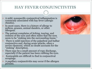 HAY FEVER CONJUNCTIVITIS
— A mild, nonspecific conjunctival inflammation is
commonly associated with hay fever (allergic
rhinitis).
— In most cases, there is a history of allergy to
pollens, grasses, animal danders, or other
allergens.
— The patient complains of itching, tearing, and
redness of the eyes and often states that the eyes
seem to be “sinking into the surrounding tissue.”
— There is mild injection of the palpebral and bulbar
conjunctiva and, during acute attacks, often a
severe chemosis, which no doubt accounts for the
“sinking” description.
— There may be a small amount of ropy discharge,
especially if the patient has been rubbing the eyes.
— Eosinophils are difficult to find in conjunctival
scrapings.
— A papillary conjunctivitis may occur if the allergen
persists.
 