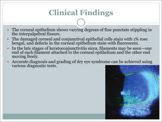 Clinical Findings
— The corneal epithelium shows varying degrees of fine punctate stippling in
the interpalpebral fissure.
— The damaged corneal and conjunctival epithelial cells stain with 1% rose
bengal, and defects in the corneal epithelium stain with fluorescein.
— In the late stages of keratoconjunctivitis sicca, filaments may be seen—one
end of each filament attached to the corneal epithelium and the other end
moving freely.
— Accurate diagnosis and grading of dry eye syndrome can be achieved using
various diagnostic tests.
 