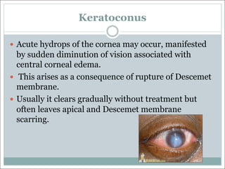 Keratoconus
— Acute hydrops of the cornea may occur, manifested
by sudden diminution of vision associated with
central corneal edema.
— This arises as a consequence of rupture of Descemet
membrane.
— Usually it clears gradually without treatment but
often leaves apical and Descemet membrane
scarring.
 