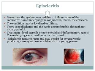 Episcleritis
— Sometimes the eye becomes red due to inflammation of the
connective tissue underlying the conjunctiva, that is, the episclera.
— The condition may be localized or diffuse.
— There is no discharge and the eye is uncomfortable although not
usually painful.
— Treatment - local steroids or non-steroid anti-inflammatory agents.
The underlying cause is often never discovered.
— Episcleritis tends to recur and may persist for several weeks
producing a worrying cosmetic blemish in a young person.
 