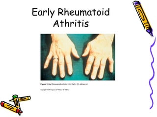 Early Rheumatoid
     Athritis
 