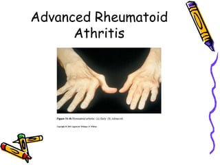 Advanced Rheumatoid
      Athritis
 