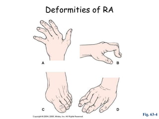 Deformities of RA




                    Fig. 63-4
 