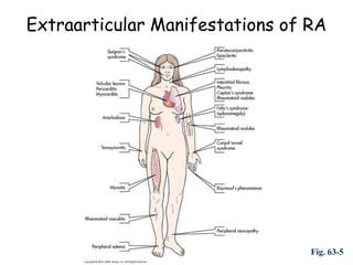 Extraarticular Manifestations of RA




                                 Fig. 63-5
 