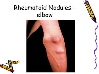 Rheumatoid Nodules -
      elbow
 