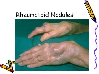 Rheumatoid Nodules
 