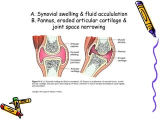 A. Synovial swelling & fluid accululation
B. Pannus, eroded articular cartilage &
        joint space narrowing
 
