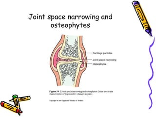 Joint space narrowing and
       osteophytes
 