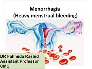 Menorrhagia
(Heavy menstrual bleeding)
DR Fahmida Rashid
Assistant Professor
CMC
 