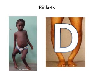 Rickets
 