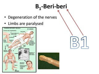 B1-Beri-beri
• Degeneration of the nerves
• Limbs are paralysed
 