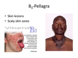 B3-Pellagra

• Skin lesions
• Scaly skin sores
 