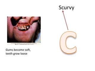 Scurvy




Gums become soft,
teeth grow loose
 