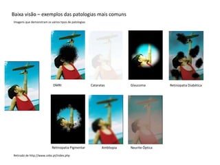 Baixa visão – exemplos das patologias mais comuns
Imagens que demonstram os vários tipos de patologias




                            DMRI                       Cataratas          Glaucoma         Retinopatia Diabética




                           Retinopatia Pigmentar              Ambliopia   Neurite Óptica

Retirado de http://www.cebv.pt/index.php
 