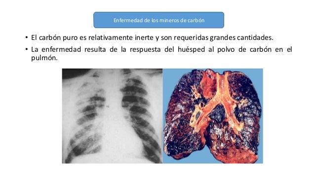 Silicosis y enfermedades pulmonares de los trabajadores de carbon