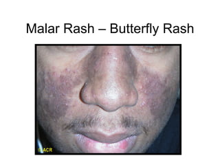 Malar Rash – Butterfly Rash
 