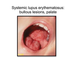 Systemic lupus erythematosus:
    bullous lesions, palate
 