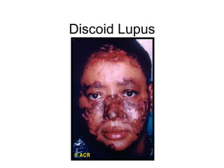 Discoid Lupus
 