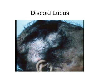 Discoid Lupus
 
