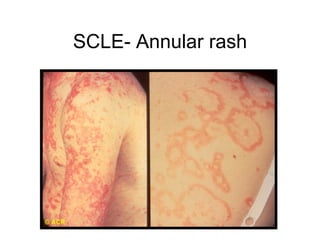 SCLE- Annular rash
 