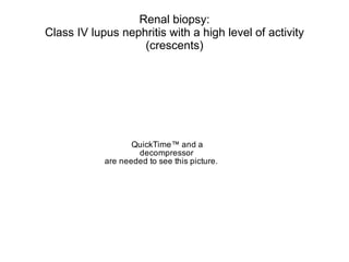 Renal biopsy:
Class IV lupus nephritis with a high level of activity
                   (crescents)




                   QuickTime™ and a
                    decompressor
            are needed to see this picture.
 