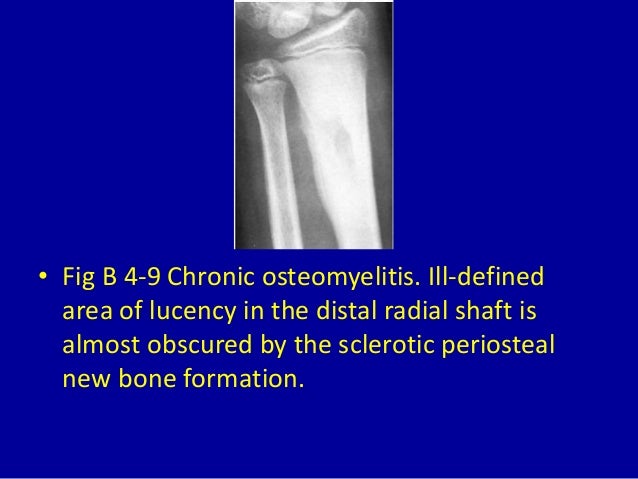 4 solitary or multiple osteosclerotic bone lesions