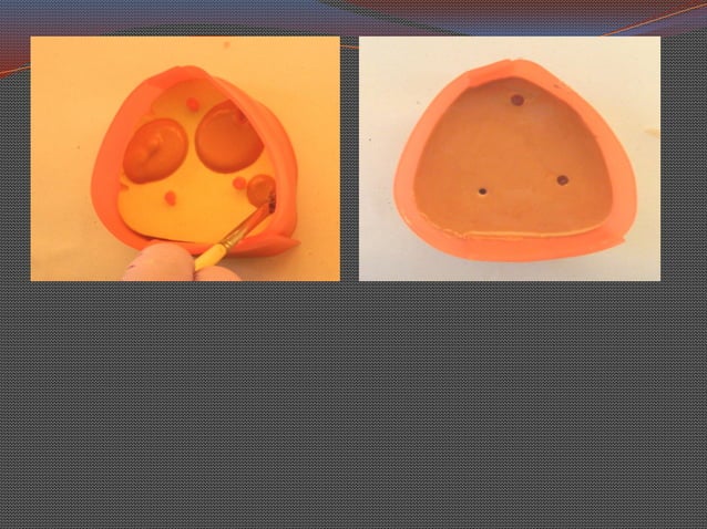 Split Cast Method 4 Split cast. complete denture lab work. | PPTX