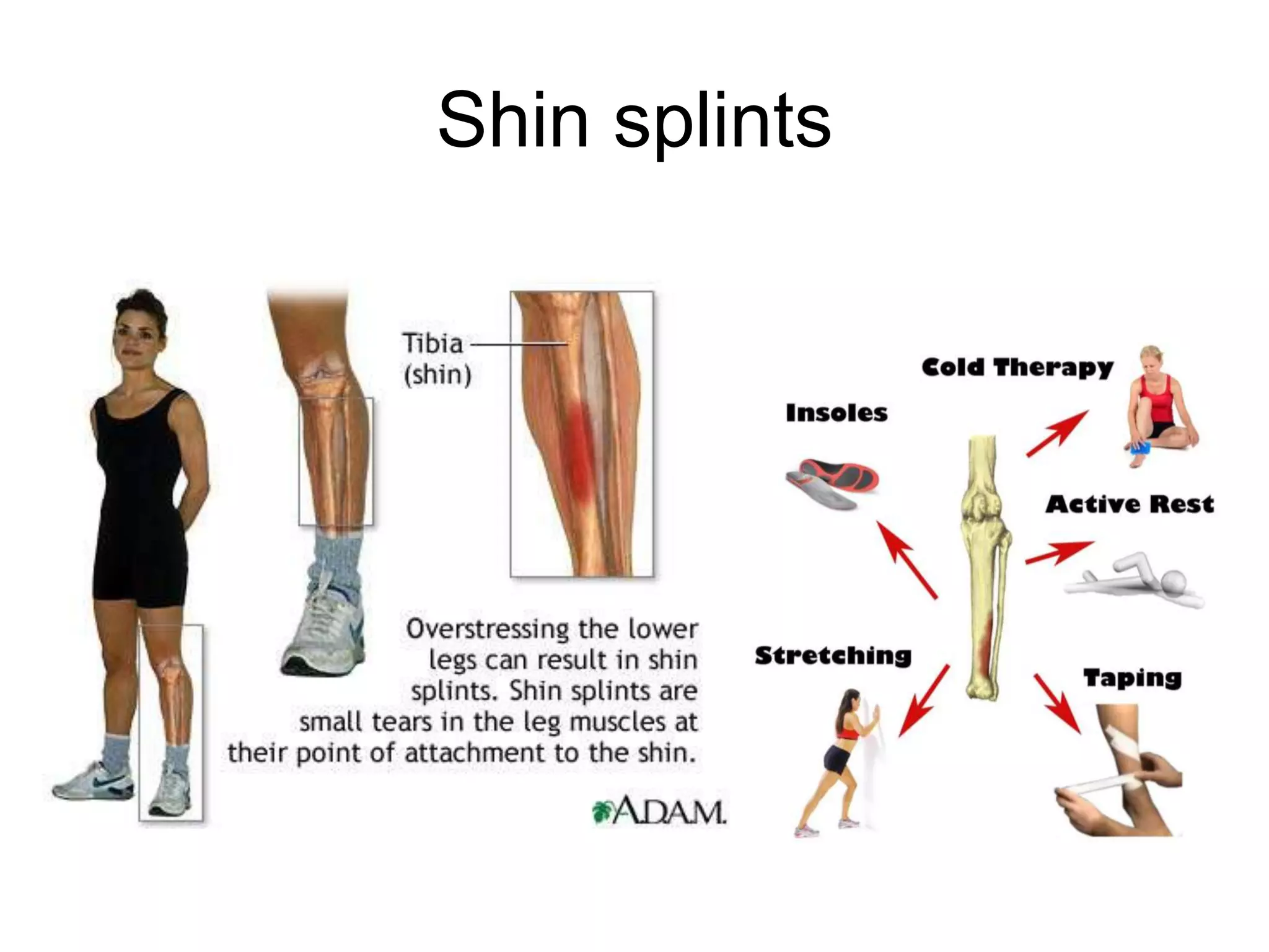 Shin splints
 
