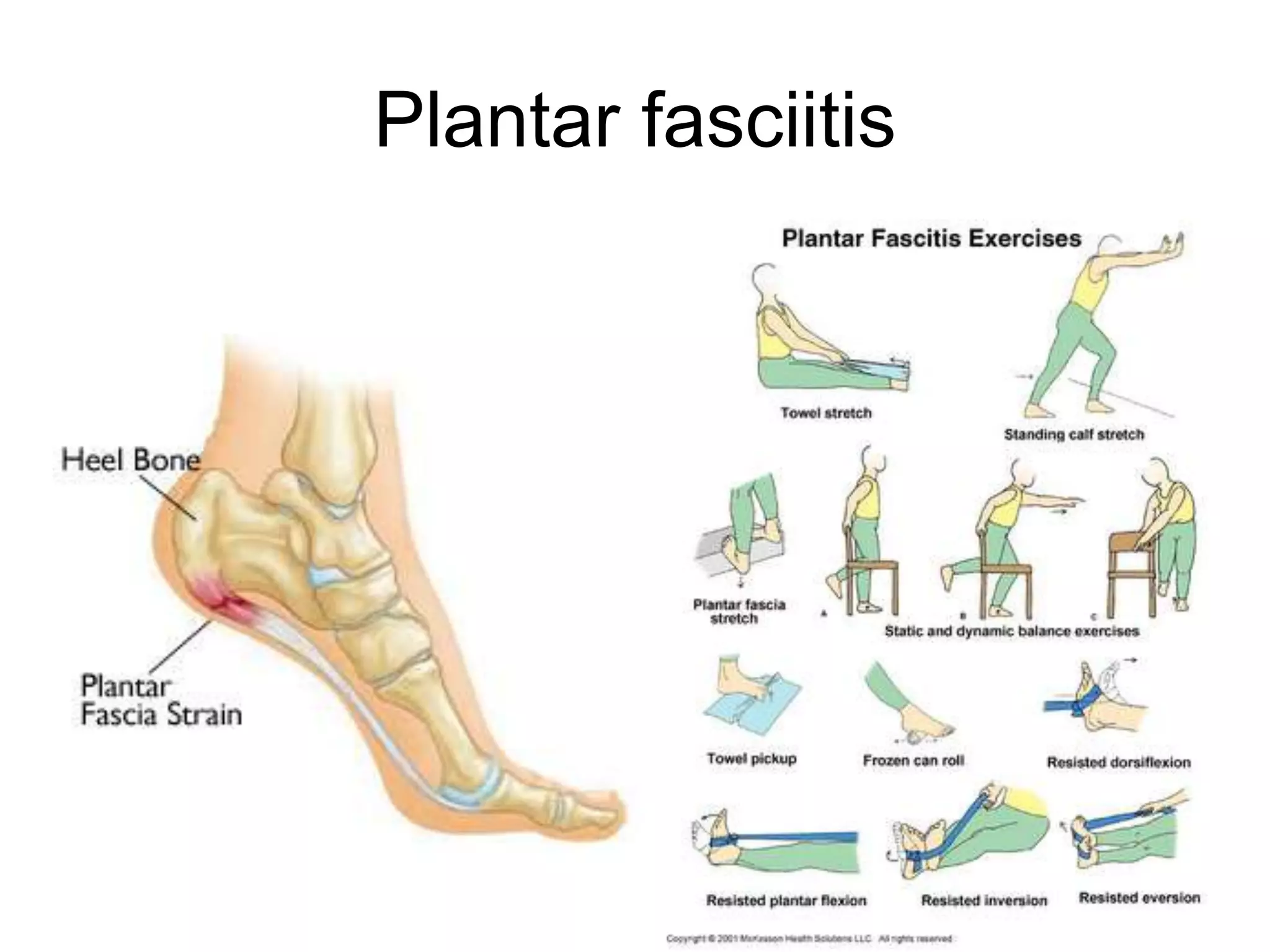 Plantar fasciitis
 