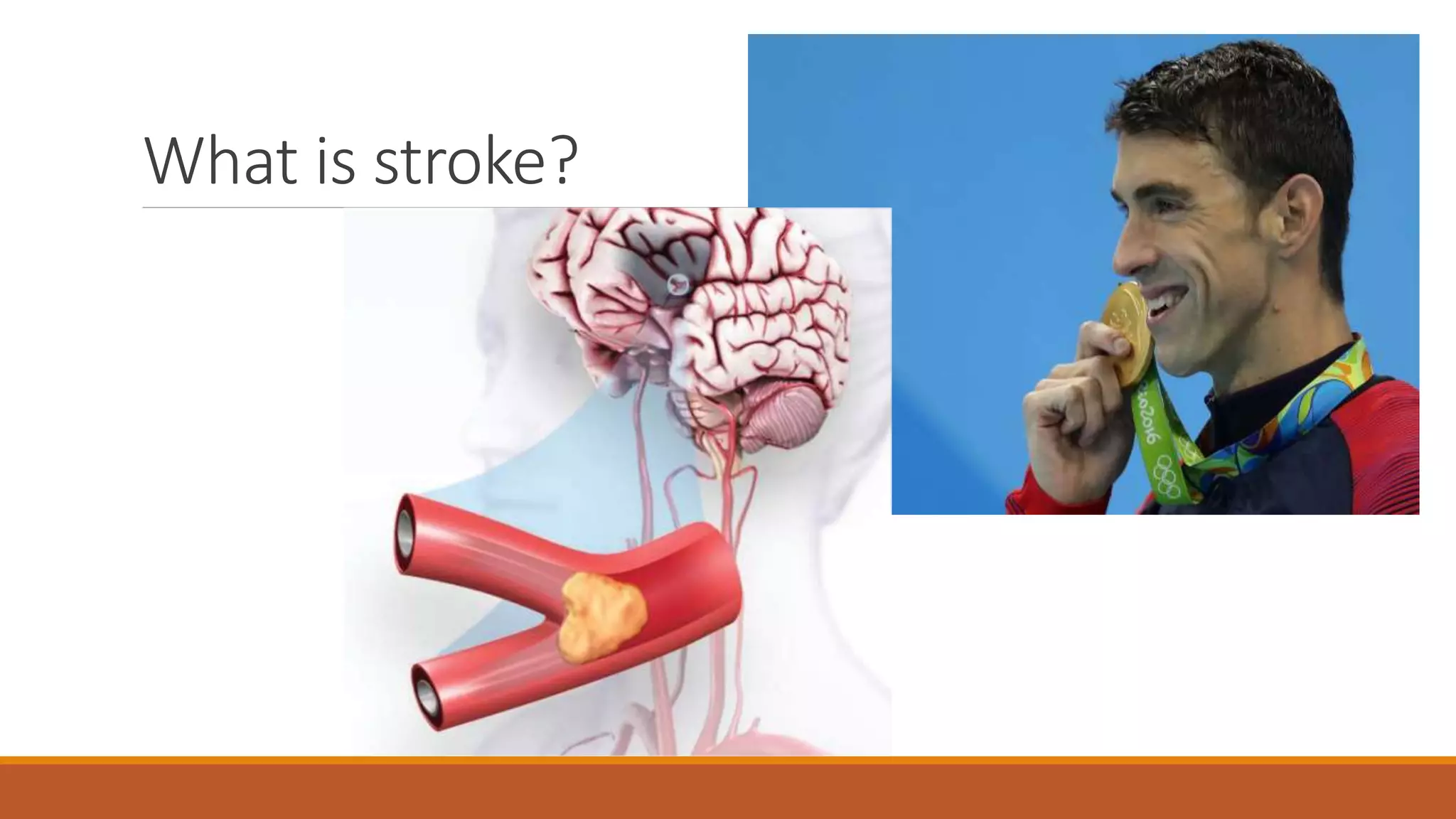 What is stroke?
 