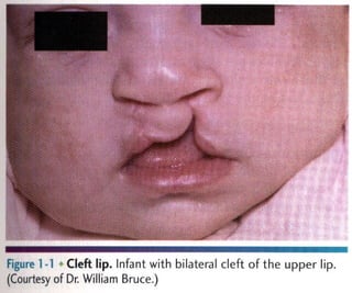 Figure 1 >1 Cleft Infant with bilateral Cleft of the upper lip.
(Courtesy of Dr, William Bruce‘)
 