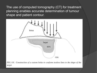 The use of computed tomography (CT) for treatment
planning enables accurate determination of tumour
shape and patient contour.
 