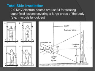 Total Skin Irradiation
2-9 MeV electron beams are useful for treating
superficial lesions covering a large areas of the body
(e.g. mycosis fungoides)
 