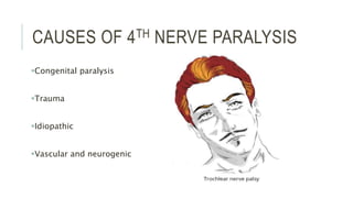 CAUSES OF 4TH NERVE PARALYSIS
Congenital paralysis
Trauma
Idiopathic
Vascular and neurogenic
 