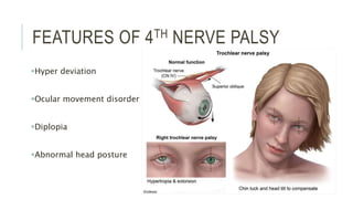 FEATURES OF 4TH NERVE PALSY
Hyper deviation
Ocular movement disorder
Diplopia
Abnormal head posture
 